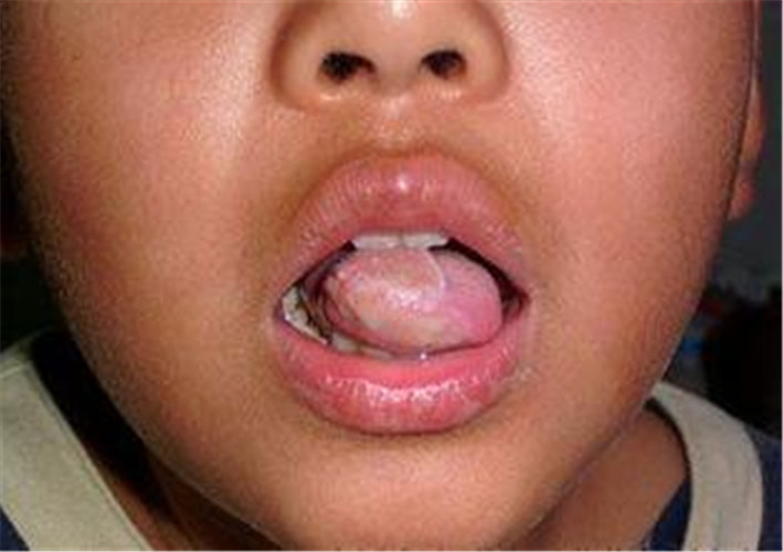 白塞病儿童舌尖图片