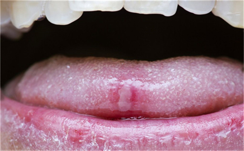 白塞病舌尖症状图片