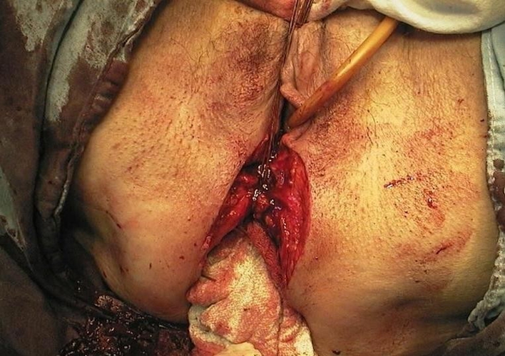 女性直肠癌经阴切除手术图片