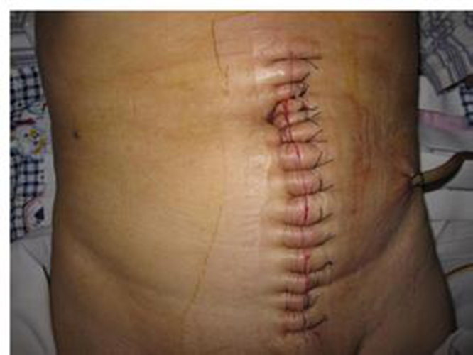 腹腔镜直肠癌手术新进展图片