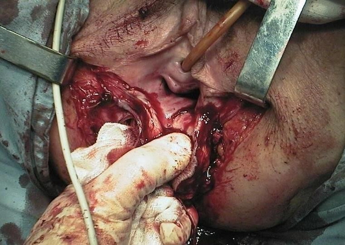 女性经阴的直肠癌切除手术图片
