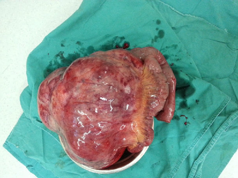 肠肿瘤手术中间图片