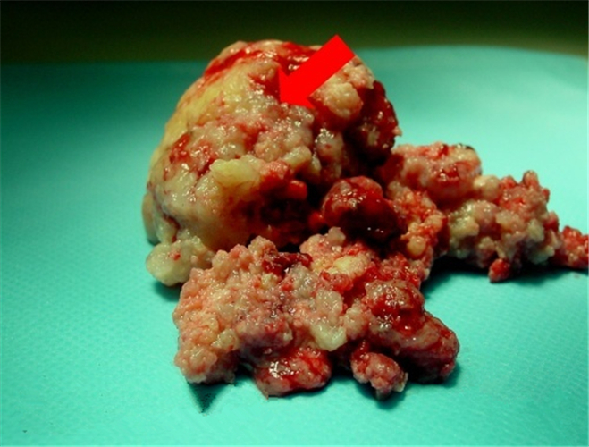 切下的巨大脑胶质瘤图片