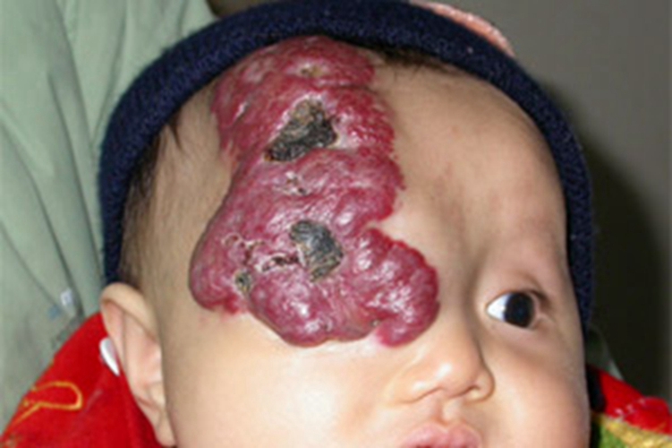 宝宝毛细血管瘤的症状图片