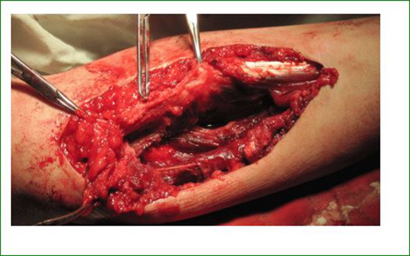 蔓状毛细血管瘤手术切除中图片