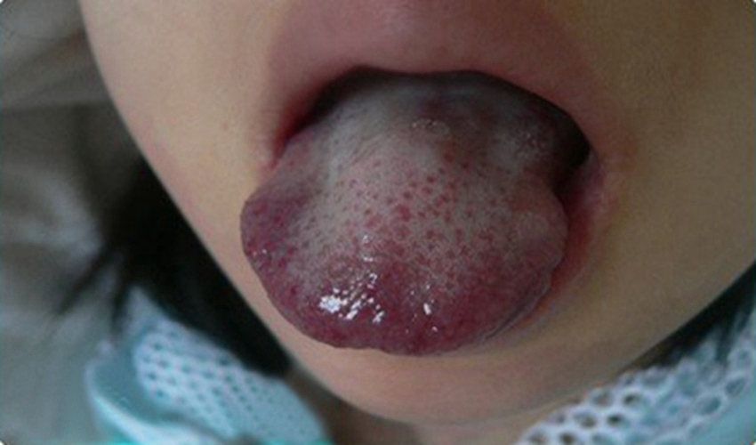 舌头淋巴毛细血管瘤图片