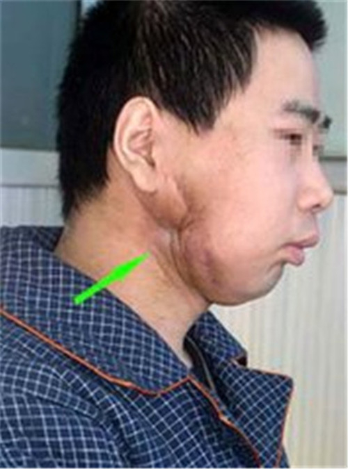 骨髓炎脸部治疗后图片