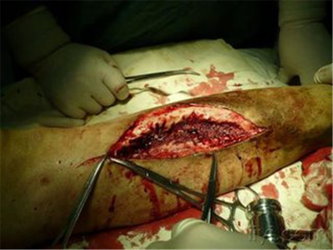 骨髓炎手术图片