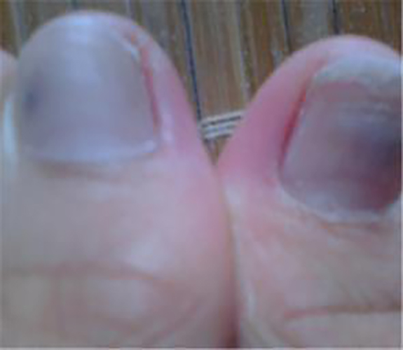 脚指甲营养不良的症状及图片