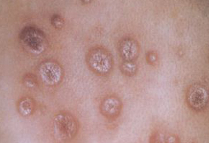 一期梅毒症状图片