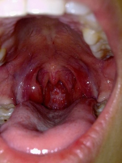 咽喉壁里白色东西癌图片