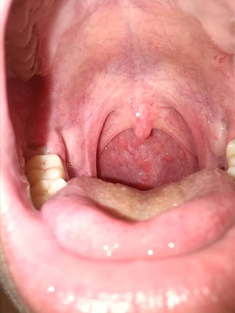 鼻咽炎初期咽喉图片