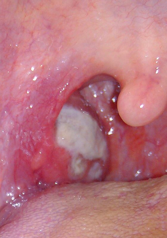 鼻咽炎咽喉部图片