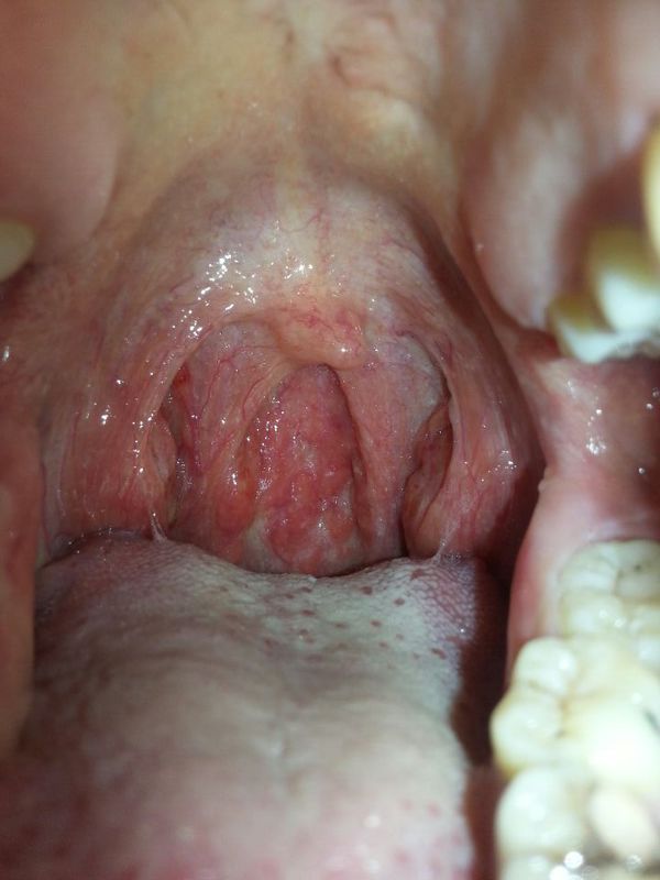 初期急性鼻咽炎图片