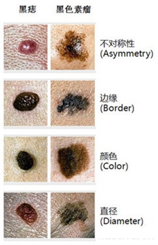 黑色素瘤与黑痣区别图片