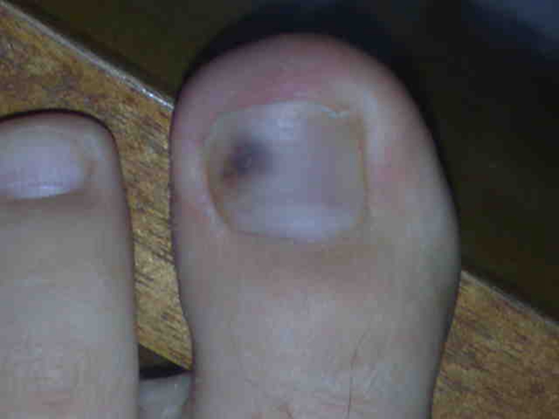 ＿脚指甲黑色素瘤图片