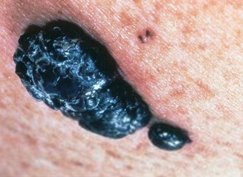 阴囊黑色素瘤图片