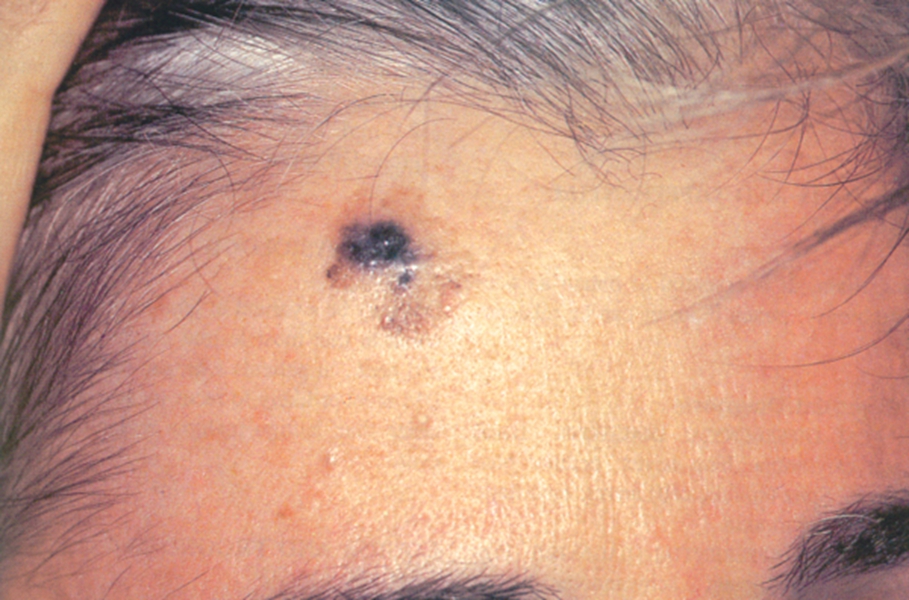 黑色素瘤头皮图片