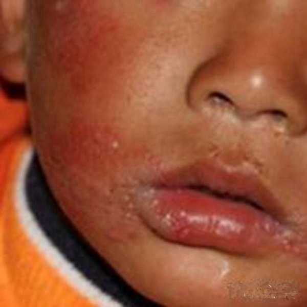 儿童口唇疱疹症状图片图片