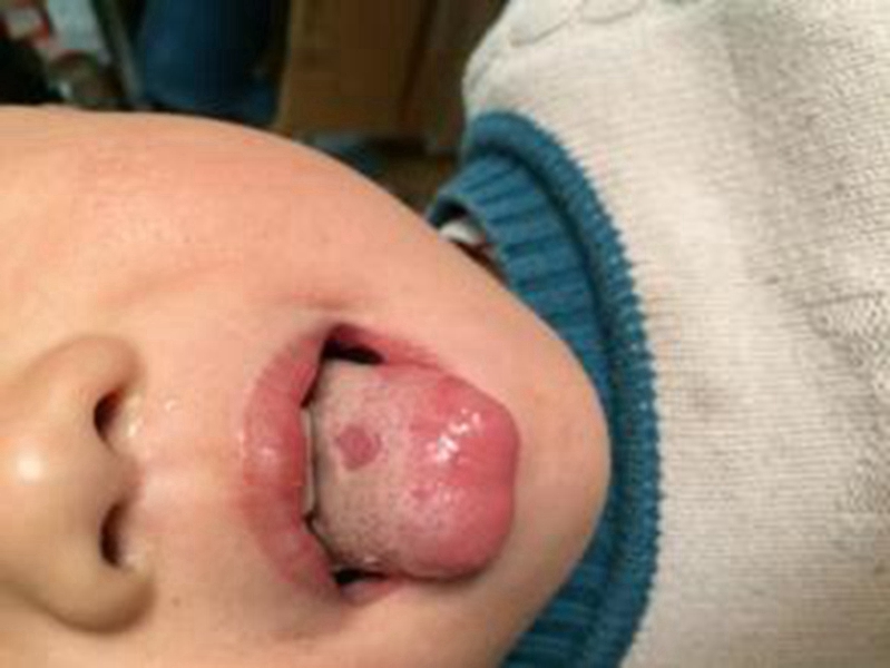 婴儿病毒性疱疹图片图片