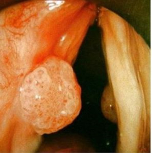 喉肿瘤图片是什么样子的图片