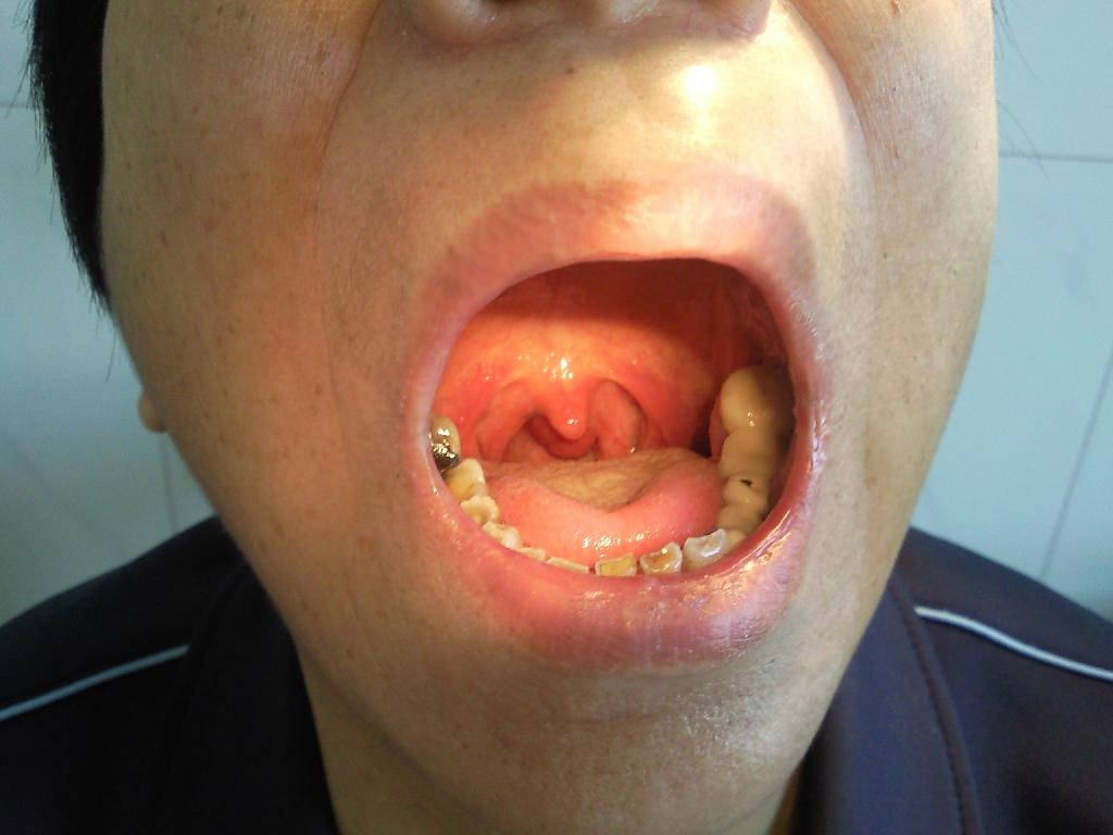 良性喉肿瘤图片