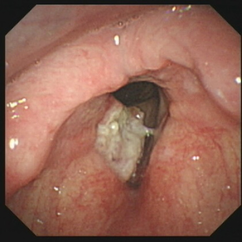 口腔喉肿瘤图片