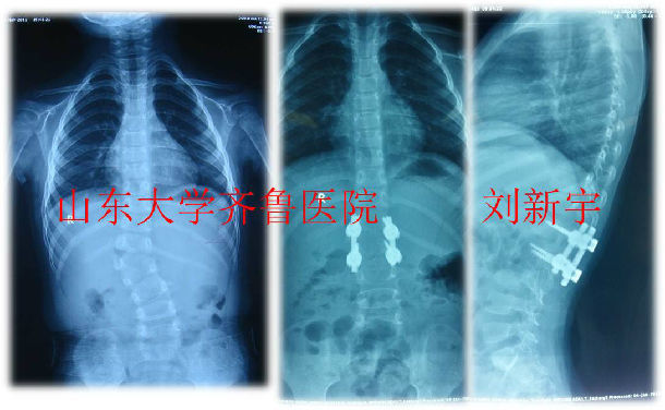 脊柱侧凸的诊断及治疗