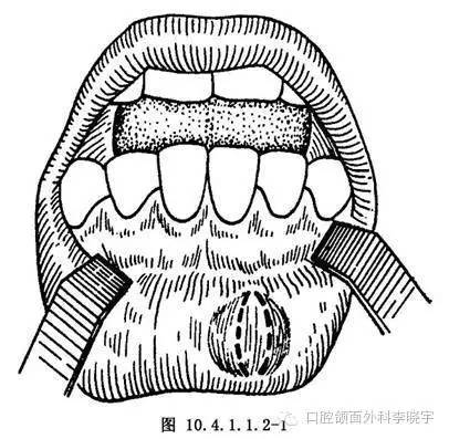 口唇粘液性囊肿