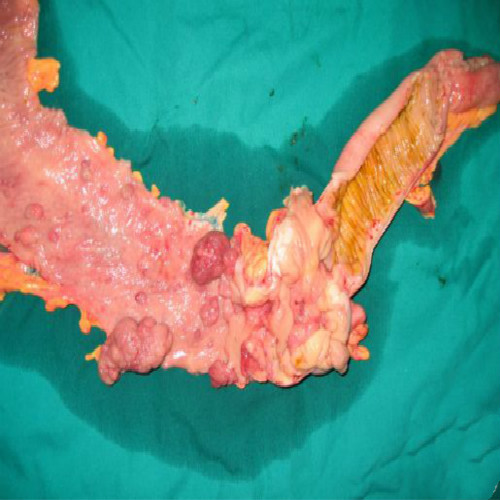 直肠息肉癌图片