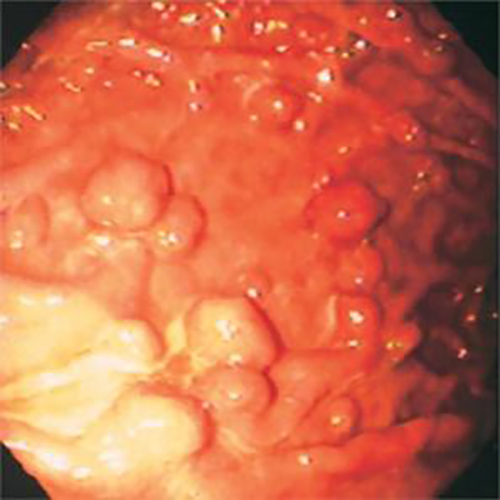 胃息肉引发胃癌的图片
