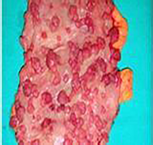 胃息肉早期表现图片