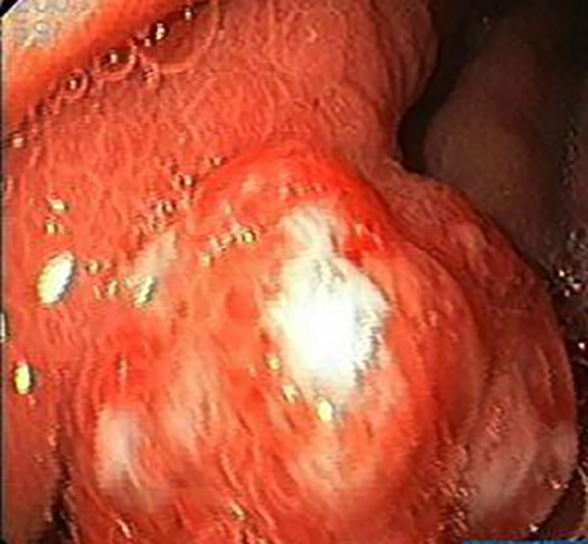 腺瘤性胃息肉图片