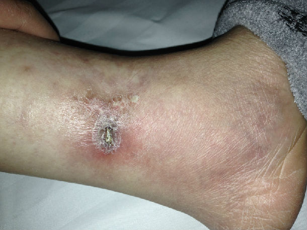 美女得了血管炎,我等助她展笑颜!(上)-有来医生