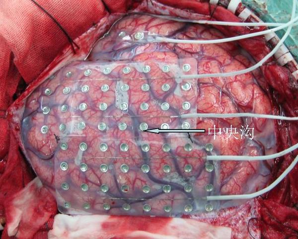 颅内电极在功能区癫痫外科治疗中的意义