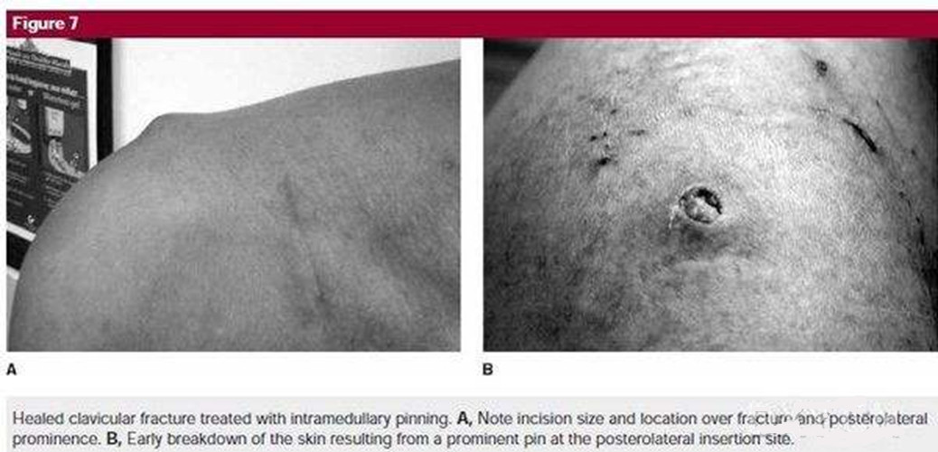 锁骨骨折的治疗进展图片