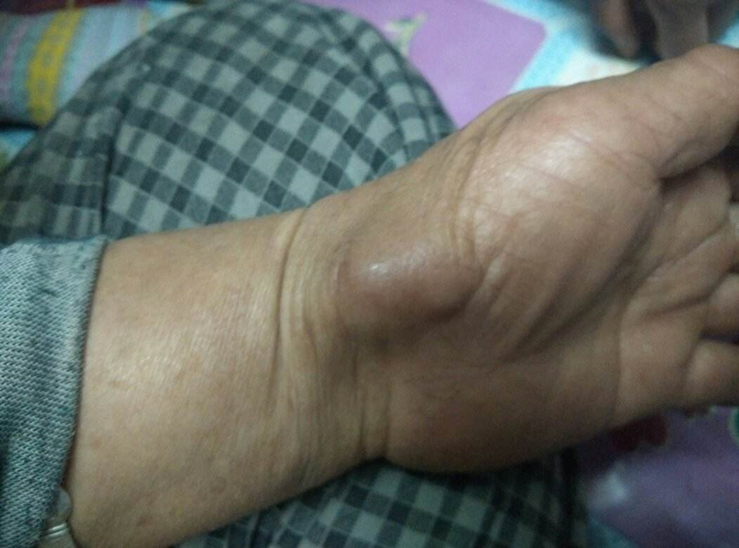 腱鞘炎图片手腕早期图片