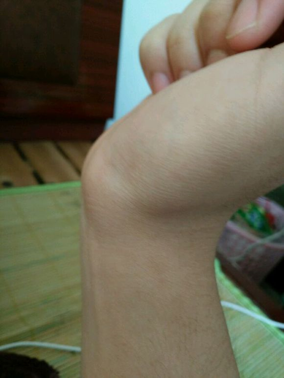 手腕腱鞘炎初期症状图片