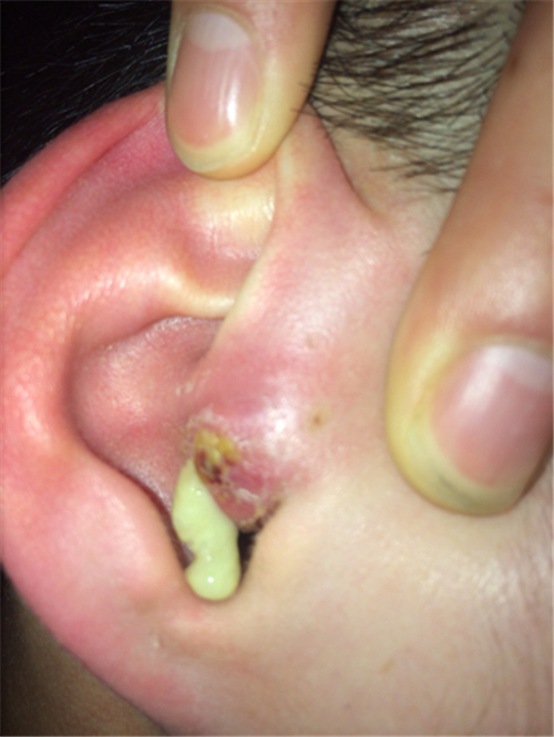 外耳道炎流脓图片