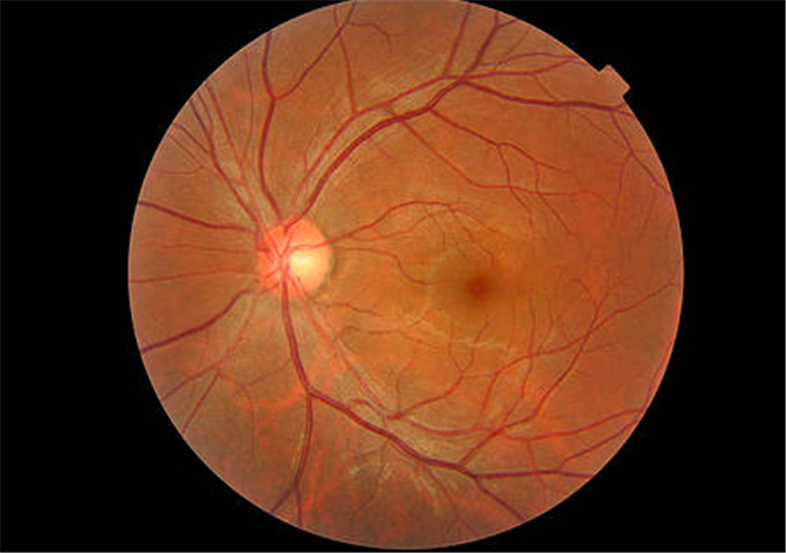 视网膜脱离的oct图片图片