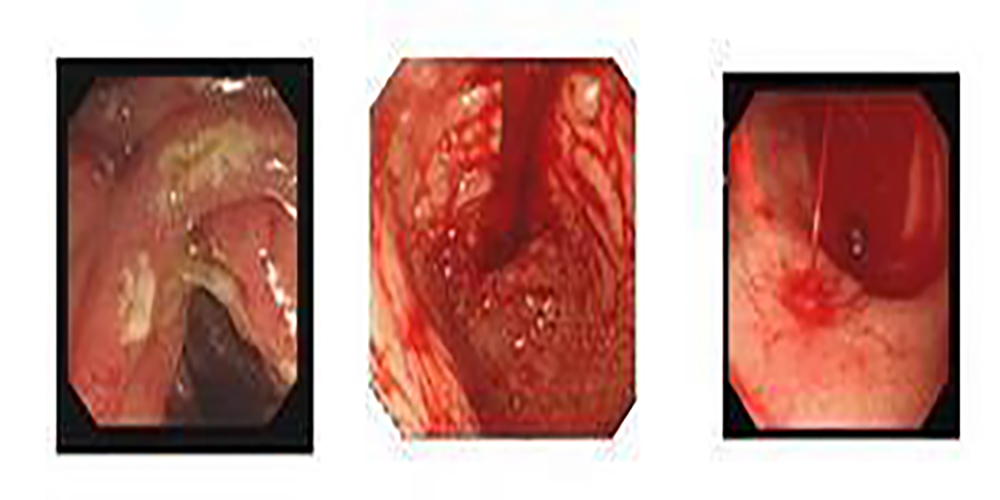 胃息肉的形成过程图片