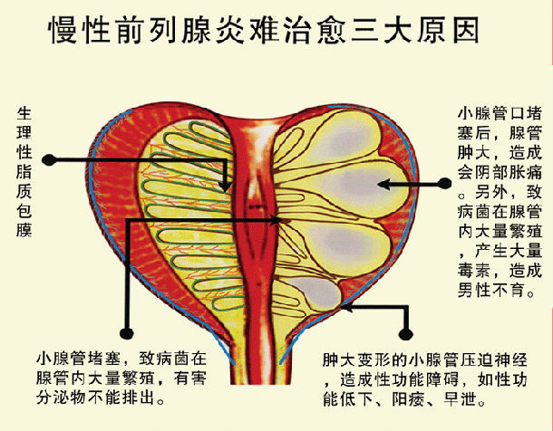 清晨尿道口有粘液,粘絲及膿液分泌,尿液混濁或小便後滴白,嚴重時出現