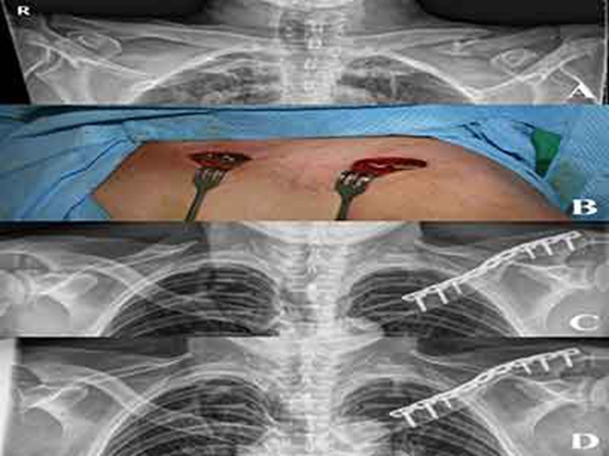 锁骨骨折开放复位的图片