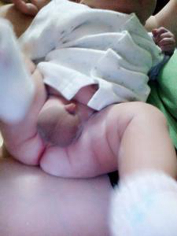 男婴鞘膜积液症状图片
