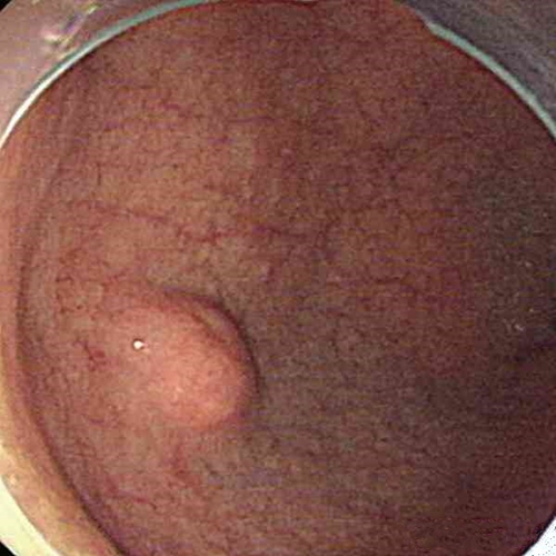 十二指肠肠溃疡颗粒细胞瘤病例图片