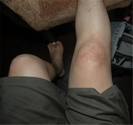 膝盖痛风石初期症状图片