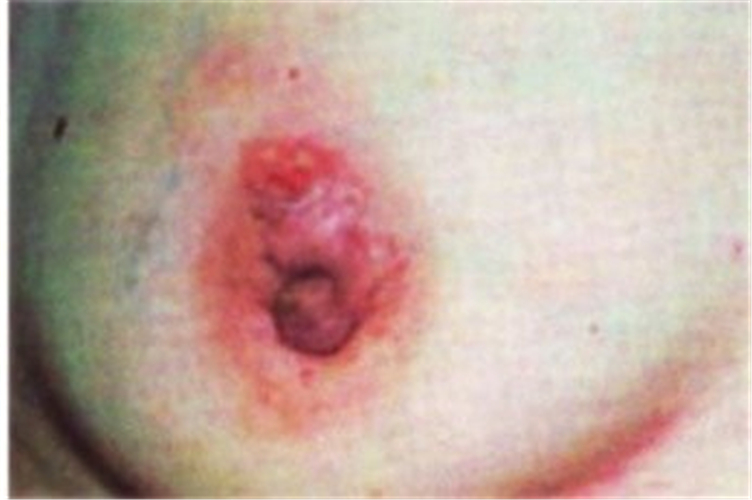 乳腺纤维瘤乳房图片