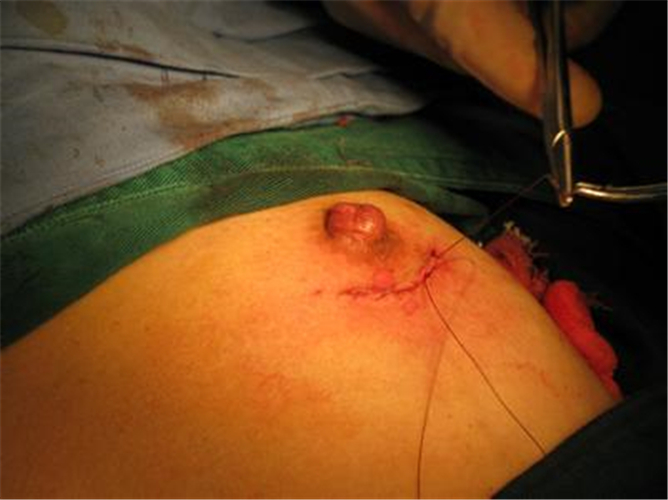 乳腺纤维瘤手术缝合图片