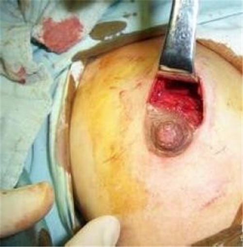 乳腺纤维瘤手术中图片