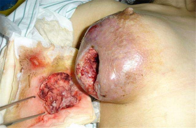 手术治疗乳腺纤维瘤图片